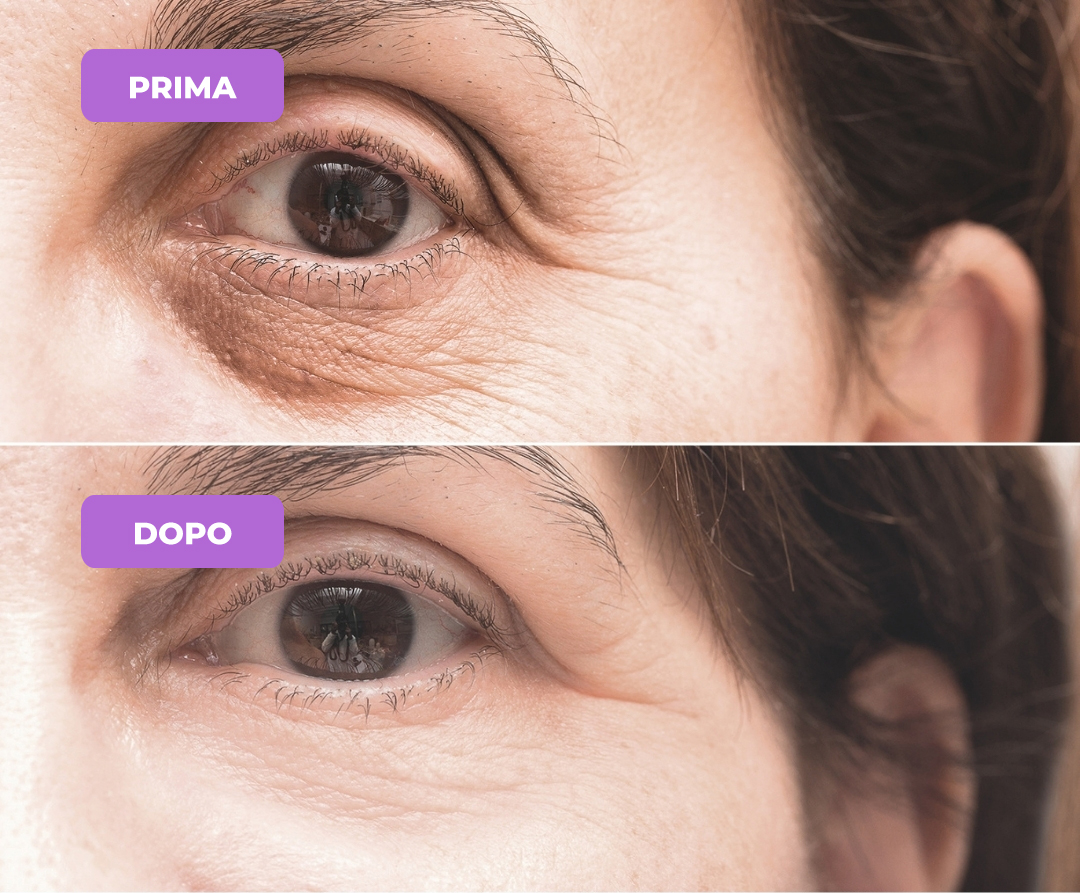 Trattamento rughe perioculari