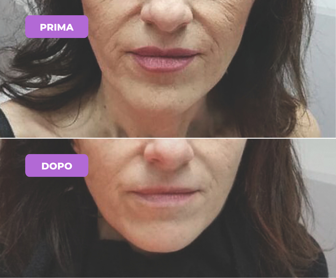 Trattamento rughe del viso