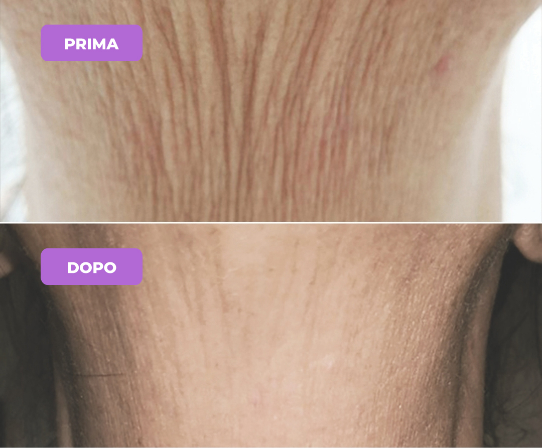 Trattamento rughe del collo