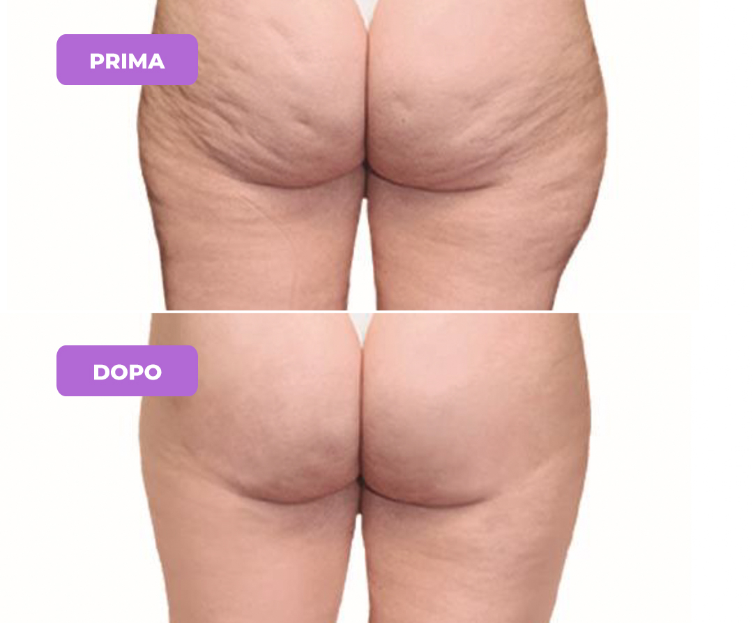 Trattamento Cellulite