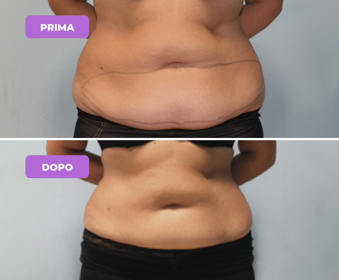 Trattamento adiposità localizzate