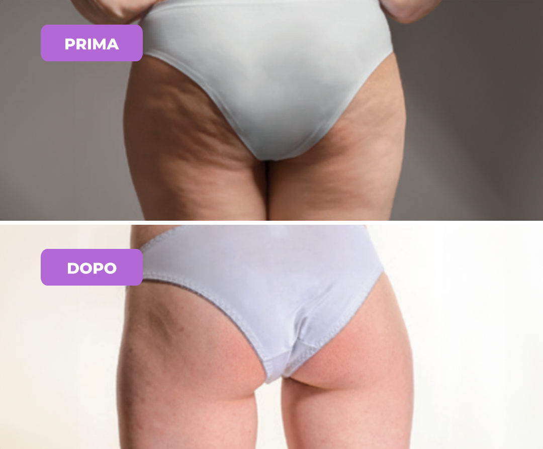 Trattamento della Cellulite