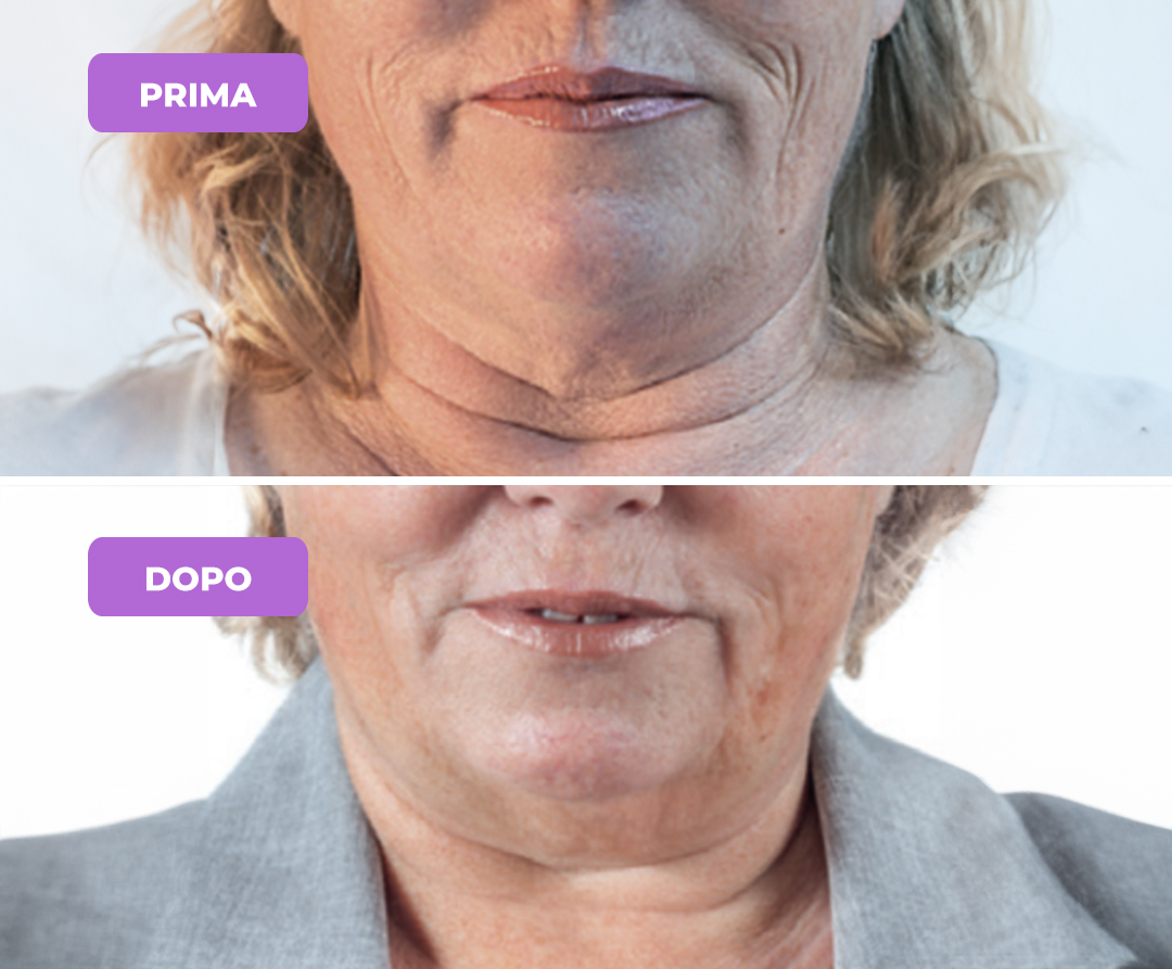Trattamento rughe perilabiali