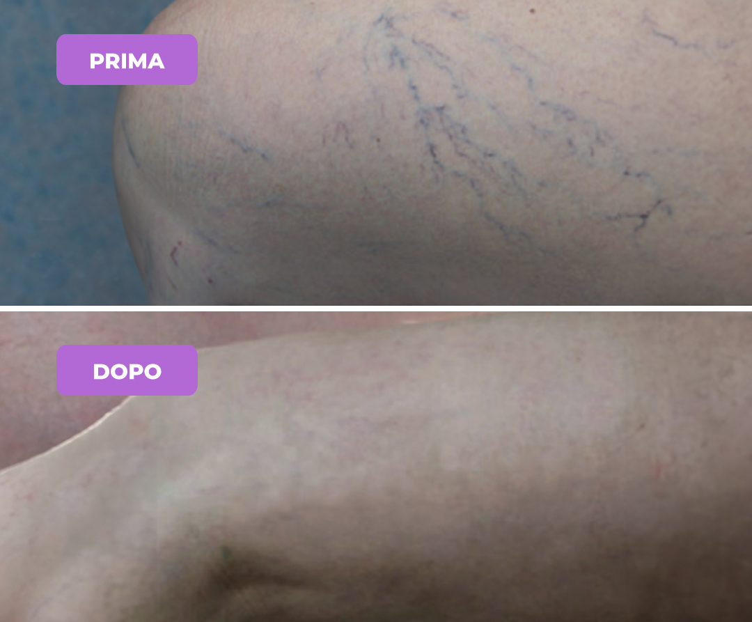 Trattamento vasculopatie arti inferiori